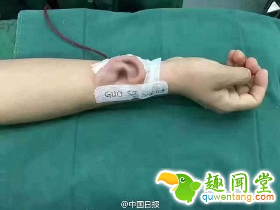 不是科幻！医生用肋骨再造耳朵