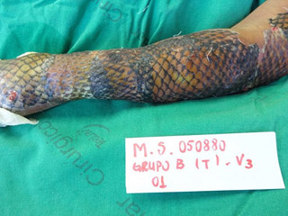 女子手臂烧伤后植入鱼皮有弹性 竟有如此