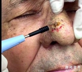 面部清洁太重要！男子懒得挤痘痘竟然累积