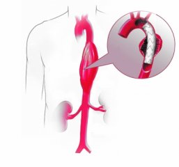 惊喜！日本研制出世界最细人工血管 直径