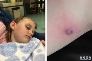 惊吓！8岁小女孩伤口爆裂 竟跑出一只蜘蛛