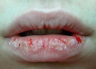 冬季嘴唇干裂很危险！这些知识你必须知道