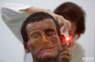 巴西一家惊悚“变脸”！皮肤在阳光下会自