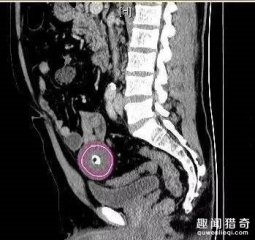 罕见！男子体内取出一圆形蛋，圆润光滑像