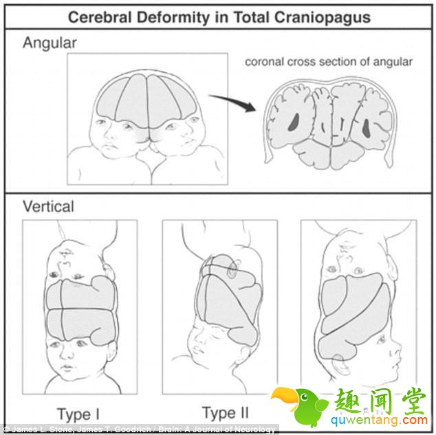 连体婴儿奇迹般存活！24小时的手术没有压倒美国这对双胞胎