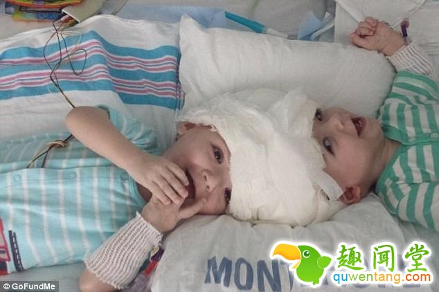 连体婴儿奇迹般存活！24小时的手术没有压倒美国这对双胞胎