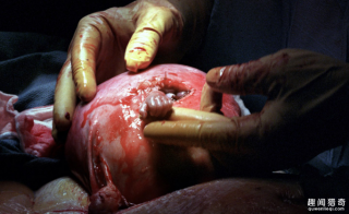 就当要放弃时「小手从子宫伸出抓住医生」