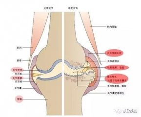 上了年纪膝盖疼，咋回事？